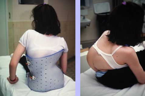 spinal brace 2